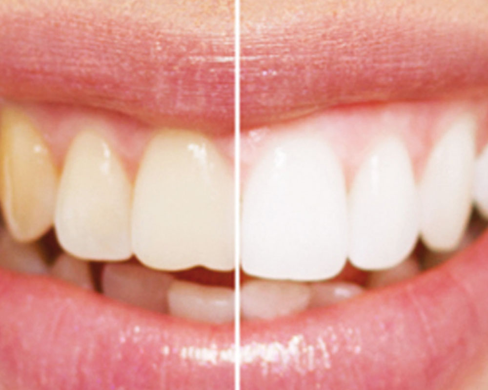 Poliambulatorio Odontoiatrico Copernico, sbiancamento professionale